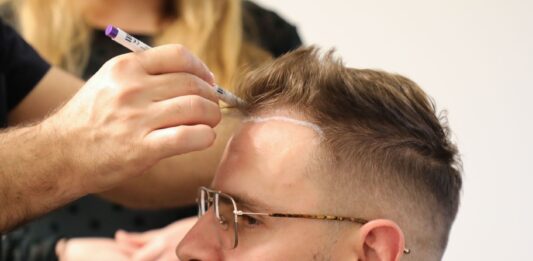 Przeszczep włosów w Turcji- zabieg medyczny czy zakupy online?