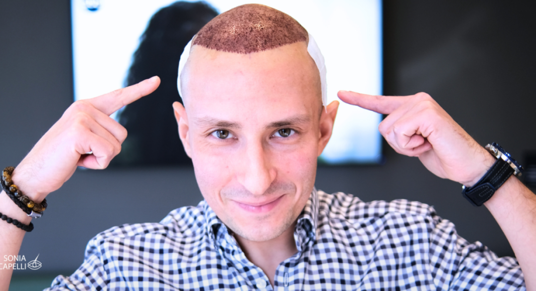 FUE czy DHI- która metoda przeszczepu włosów będzie dla mnie najlepsza?