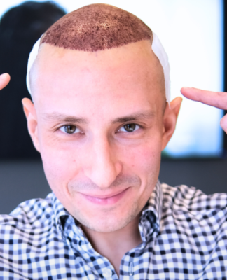 FUE czy DHI- która metoda przeszczepu włosów będzie dla mnie najlepsza?