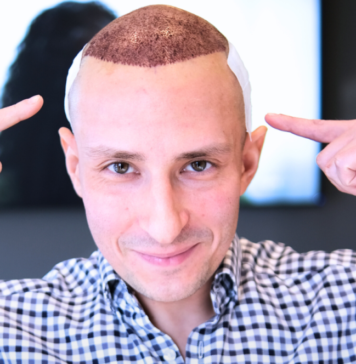 FUE czy DHI- która metoda przeszczepu włosów będzie dla mnie najlepsza?