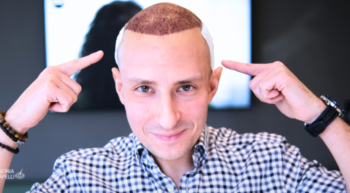 FUE czy DHI- która metoda przeszczepu włosów będzie dla mnie najlepsza?